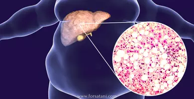 الكبد الدهني : علاج الكبد الدهني بدون ادويه في اسبوعين